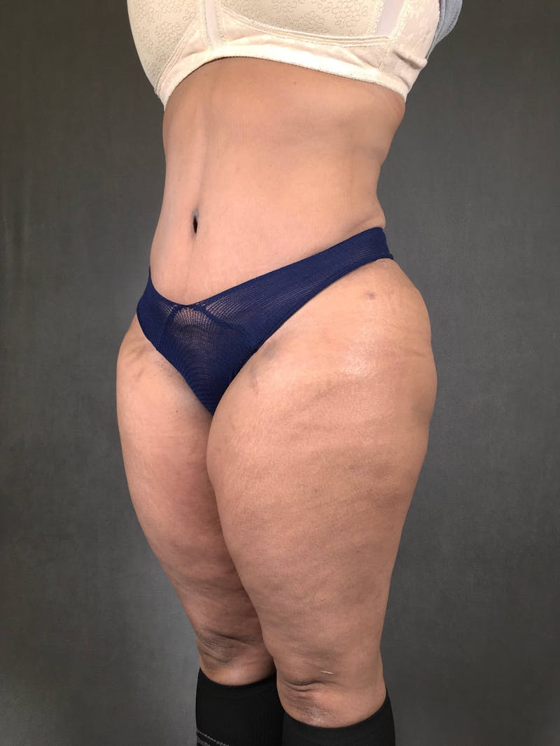 Standard Abdominoplasty Before & After Gallery - Patient 167408678 - Image 4