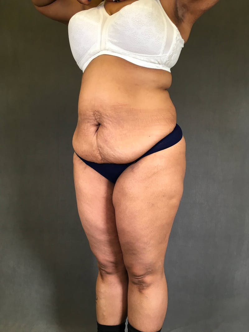 Standard Abdominoplasty Before & After Gallery - Patient 167408678 - Image 3