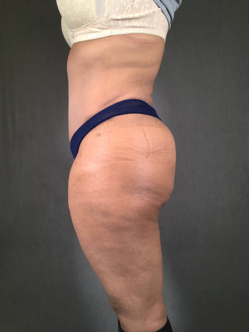Standard Abdominoplasty Before & After Gallery - Patient 167408678 - Image 6