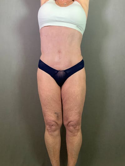 Standard Abdominoplasty Before & After Gallery - Patient 167408679 - Image 2