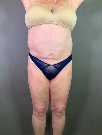 Standard Abdominoplasty Before & After Gallery - Patient 167408679 - Image 1
