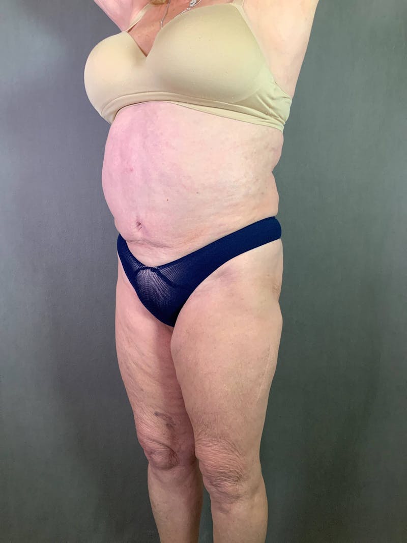 Standard Abdominoplasty Before & After Gallery - Patient 167408679 - Image 3
