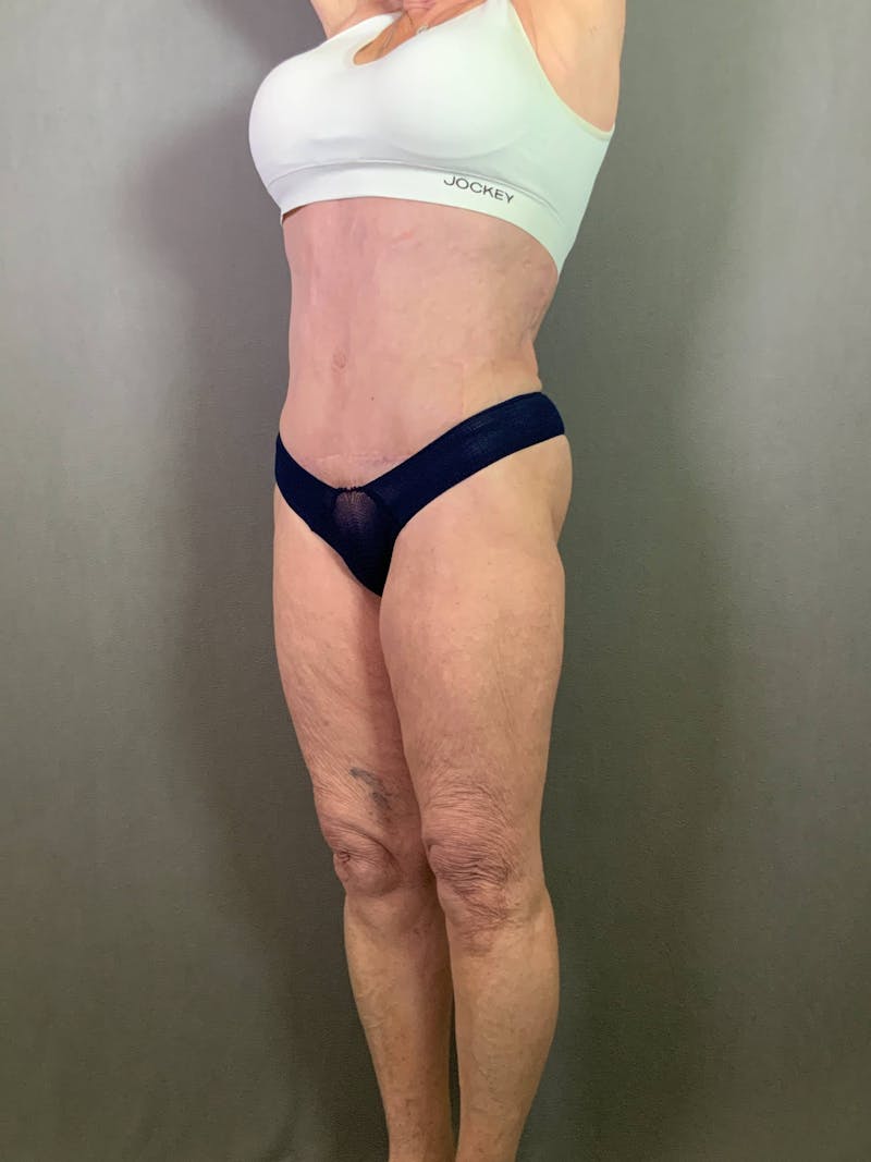 Standard Abdominoplasty Before & After Gallery - Patient 167408679 - Image 4