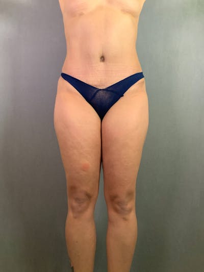 Standard Abdominoplasty Before & After Gallery - Patient 167408680 - Image 2