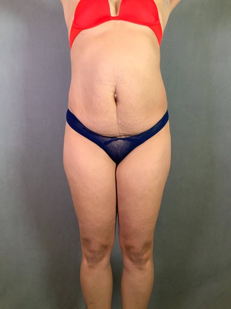 Standard Abdominoplasty Before & After Gallery - Patient 167408680 - Image 1