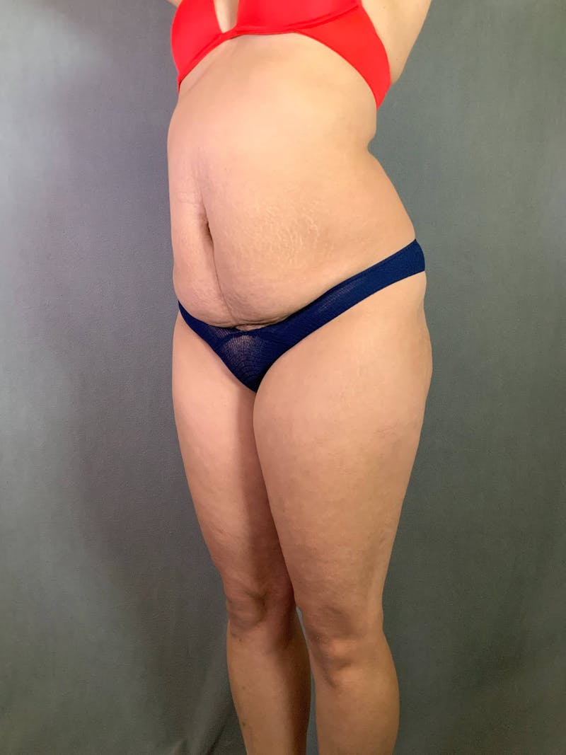 Standard Abdominoplasty Before & After Gallery - Patient 167408680 - Image 3
