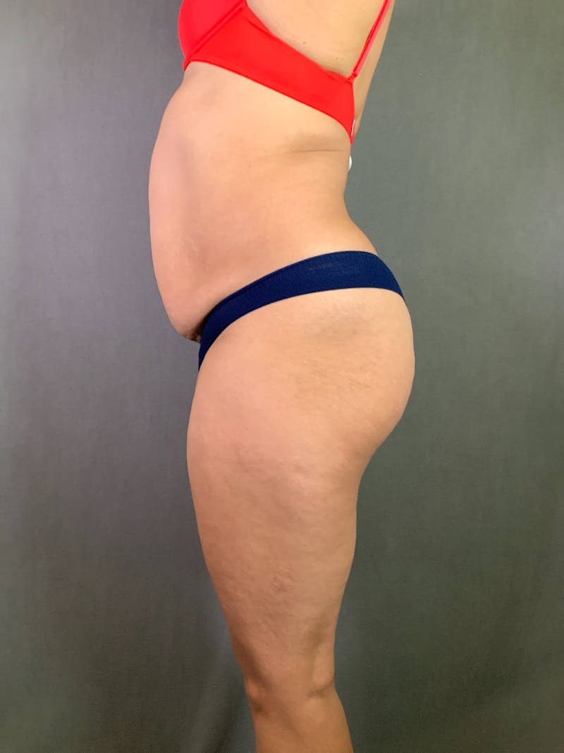 Standard Abdominoplasty Before & After Gallery - Patient 167408680 - Image 5