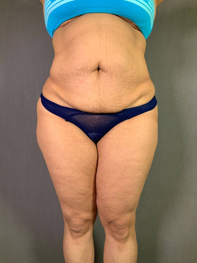 Standard Abdominoplasty Before & After Gallery - Patient 167408682 - Image 1