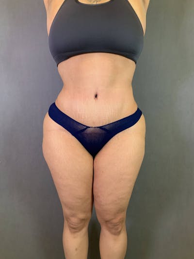 Standard Abdominoplasty Before & After Gallery - Patient 167408682 - Image 2