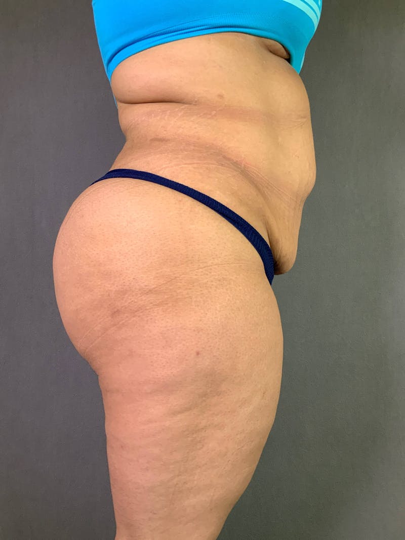 Standard Abdominoplasty Before & After Gallery - Patient 167408682 - Image 3