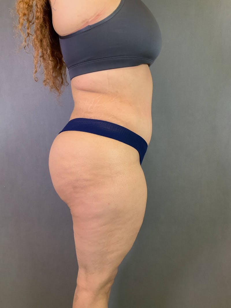 Standard Abdominoplasty Before & After Gallery - Patient 167408682 - Image 4