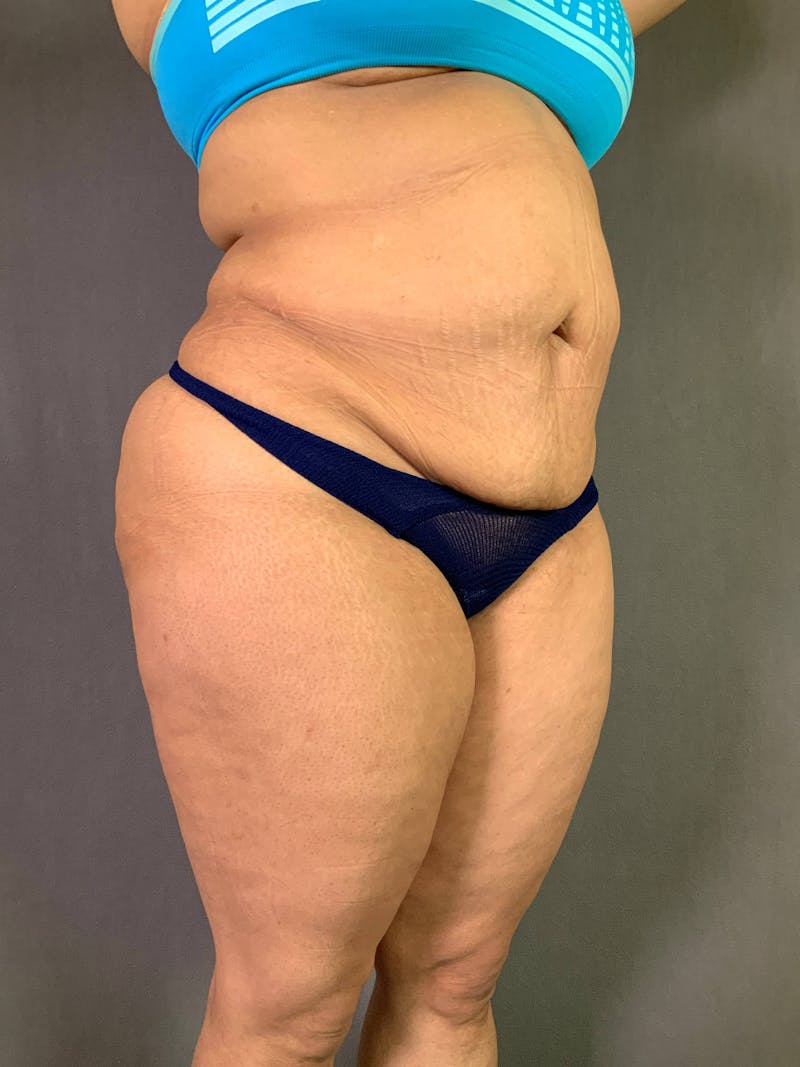 Standard Abdominoplasty Before & After Gallery - Patient 167408682 - Image 5
