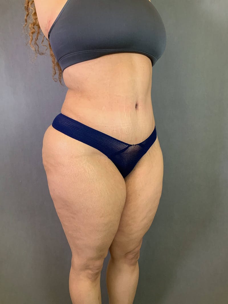 Standard Abdominoplasty Before & After Gallery - Patient 167408682 - Image 6
