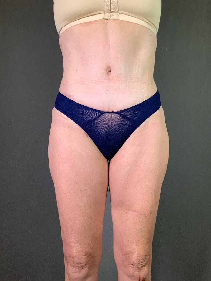 Standard Abdominoplasty Before & After Gallery - Patient 167408683 - Image 2