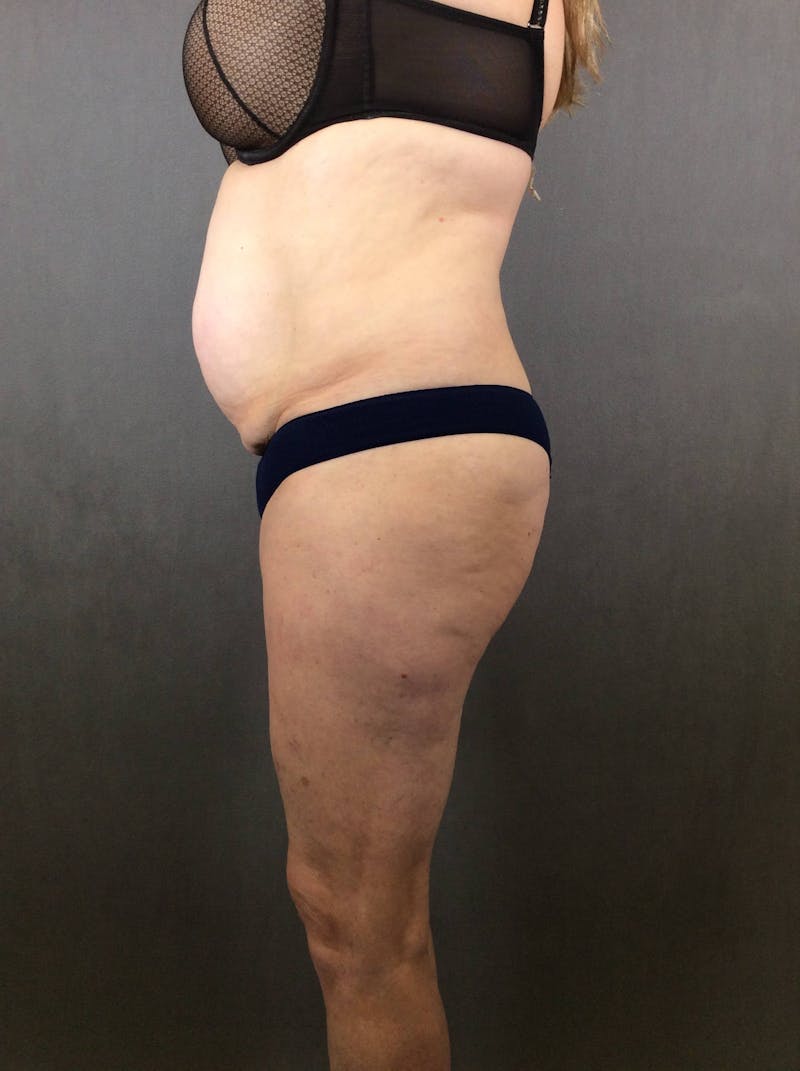 Standard Abdominoplasty Before & After Gallery - Patient 167408683 - Image 5