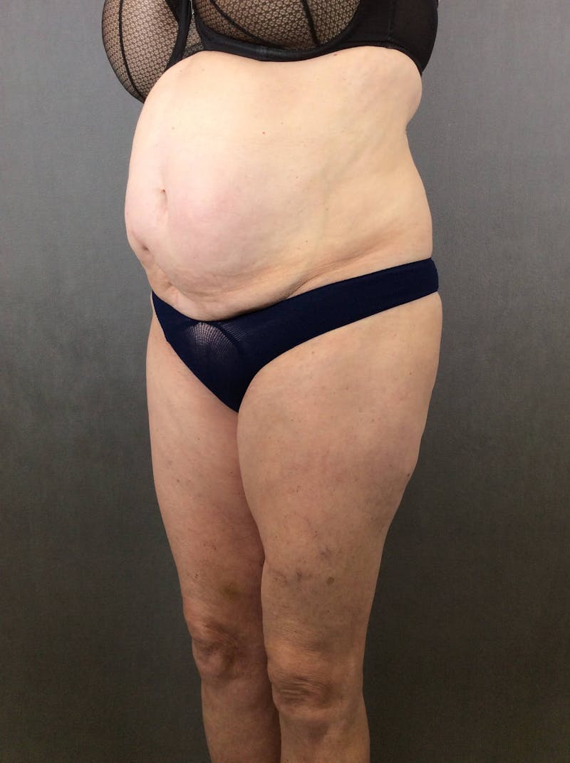 Standard Abdominoplasty Before & After Gallery - Patient 167408683 - Image 3