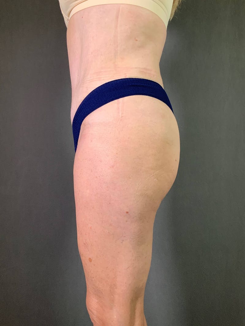 Standard Abdominoplasty Before & After Gallery - Patient 167408683 - Image 6