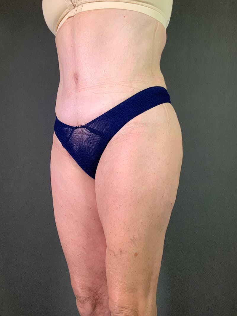 Standard Abdominoplasty Before & After Gallery - Patient 167408683 - Image 4