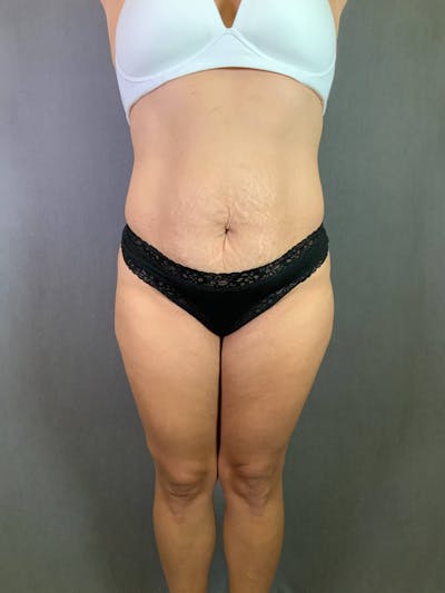 Standard Abdominoplasty Before & After Gallery - Patient 167408688 - Image 1