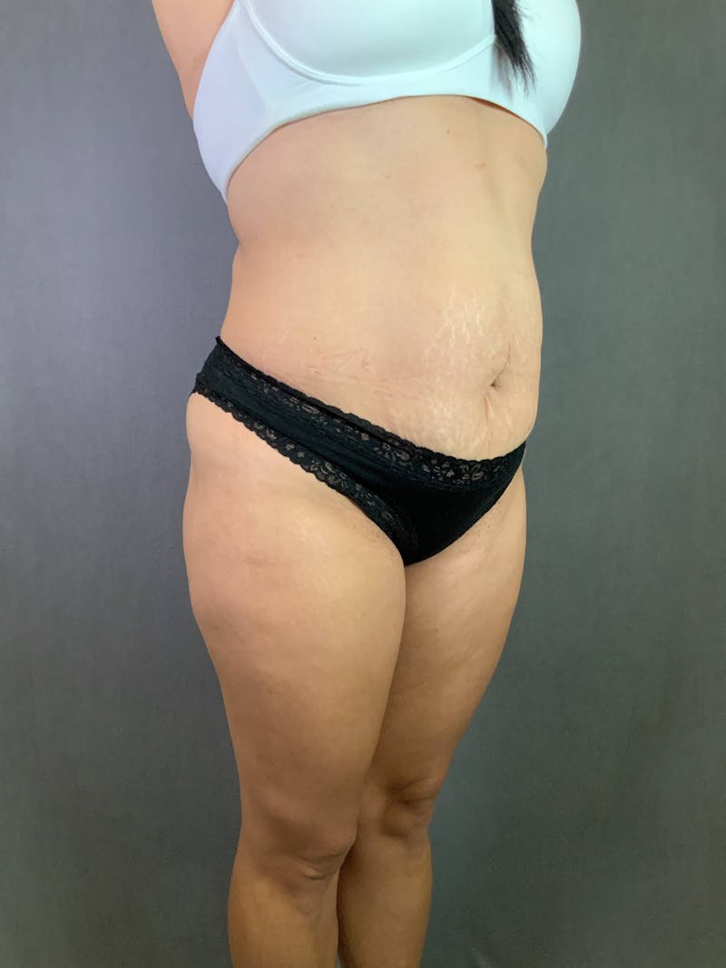 Standard Abdominoplasty Before & After Gallery - Patient 167408688 - Image 3