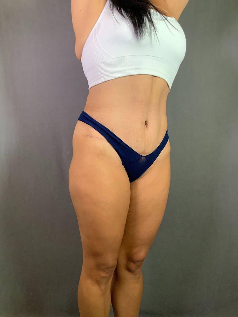 Standard Abdominoplasty Before & After Gallery - Patient 167408688 - Image 4