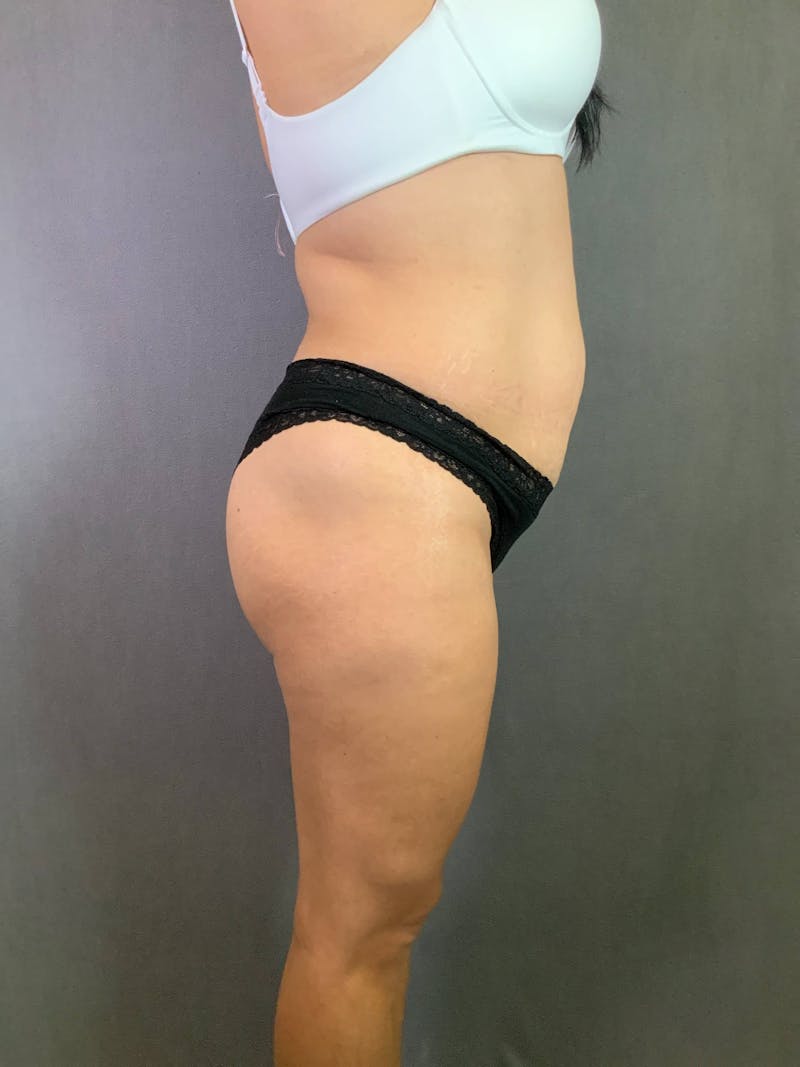 Standard Abdominoplasty Before & After Gallery - Patient 167408688 - Image 5