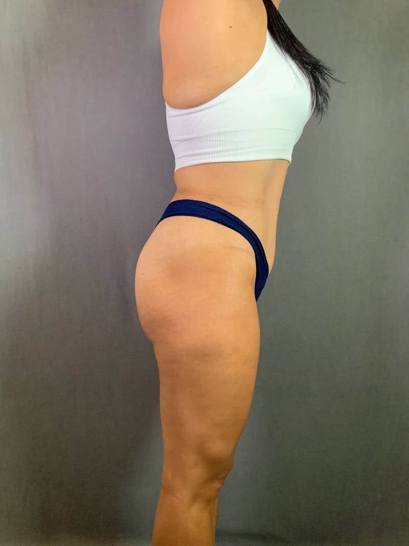 Standard Abdominoplasty Before & After Gallery - Patient 167408688 - Image 6