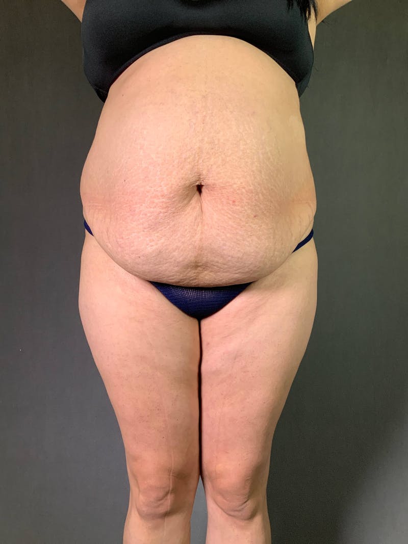 Standard Abdominoplasty Before & After Gallery - Patient 167408689 - Image 1