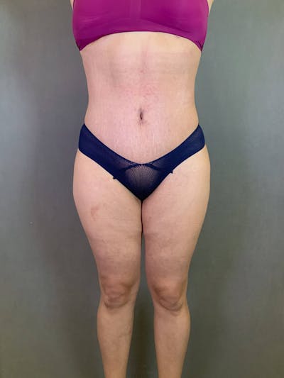Standard Abdominoplasty Before & After Gallery - Patient 167408689 - Image 2