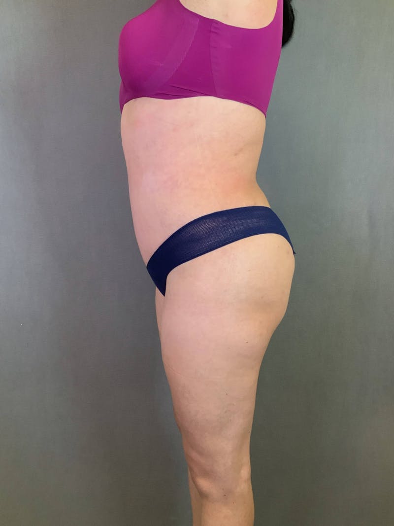 Standard Abdominoplasty Before & After Gallery - Patient 167408689 - Image 6