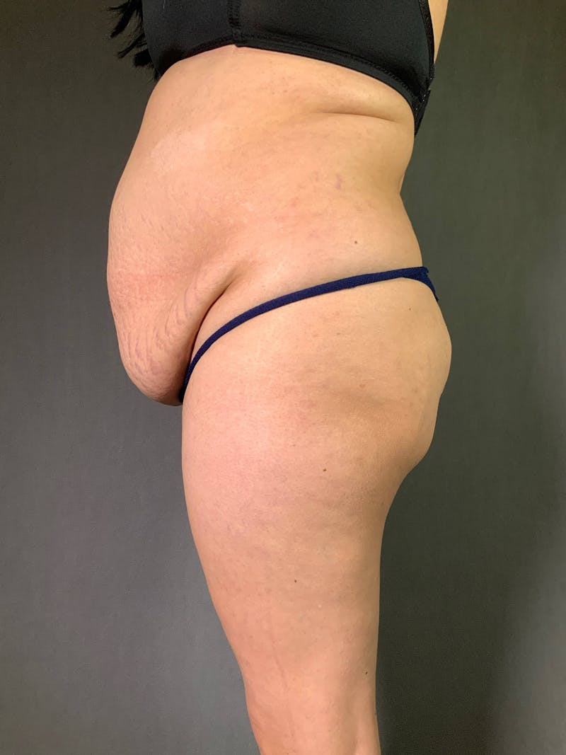 Standard Abdominoplasty Before & After Gallery - Patient 167408689 - Image 5