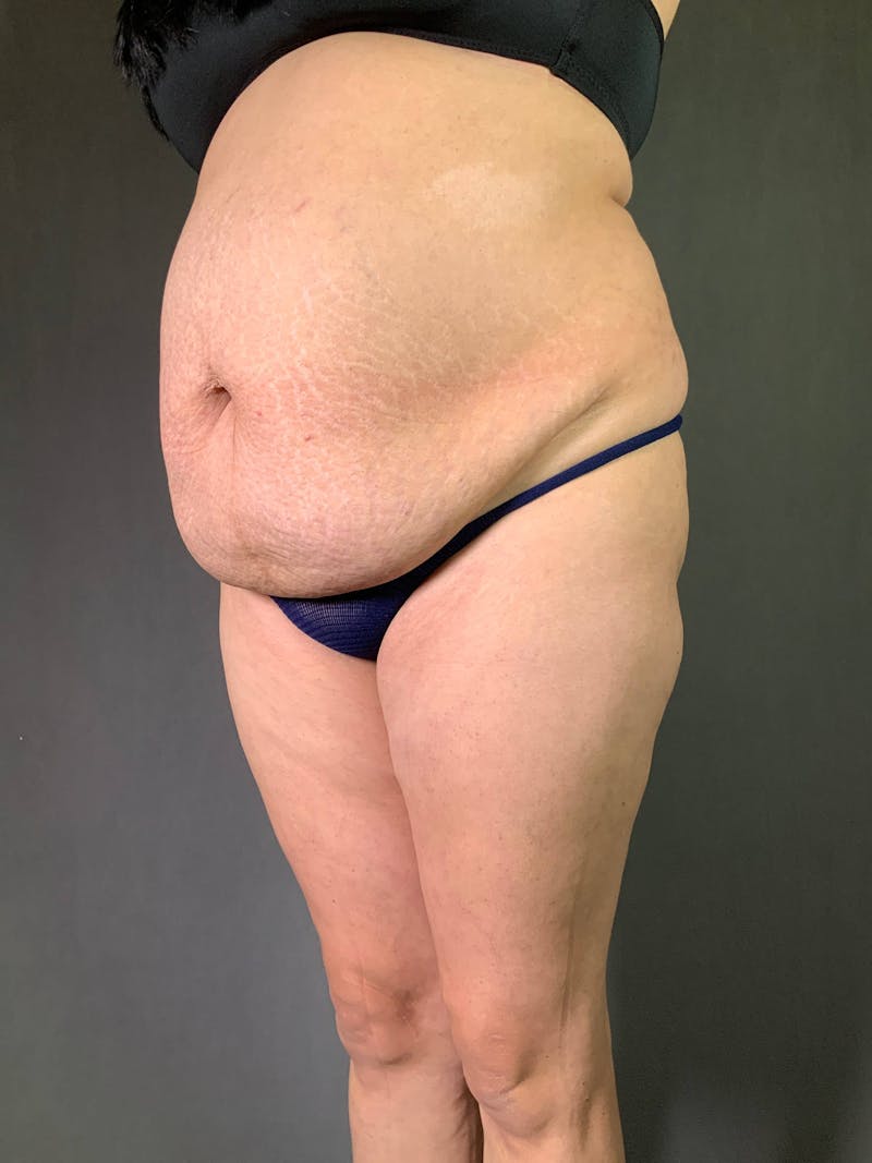 Standard Abdominoplasty Before & After Gallery - Patient 167408689 - Image 3
