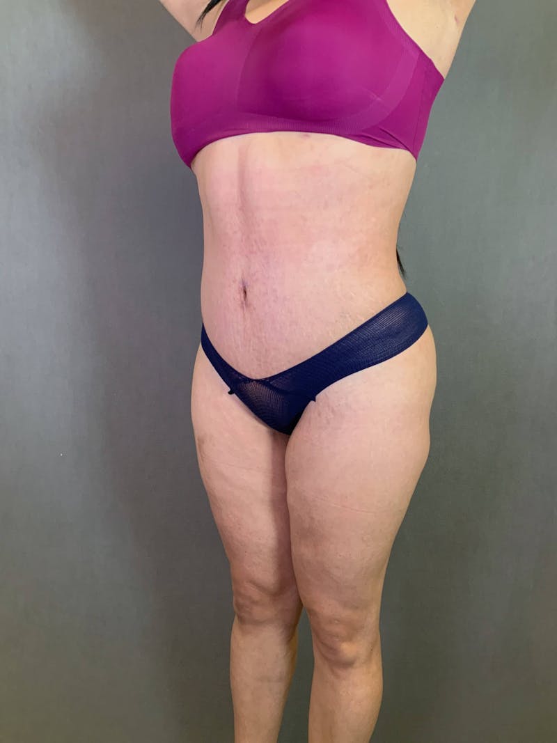 Standard Abdominoplasty Before & After Gallery - Patient 167408689 - Image 4