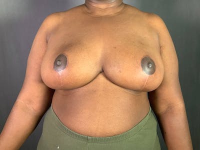 Breast Reduction Before & After Gallery - Patient 167408719 - Image 2