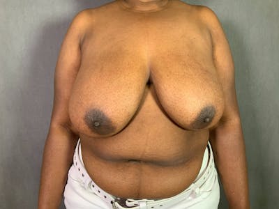 Breast Reduction Before & After Gallery - Patient 167408719 - Image 1