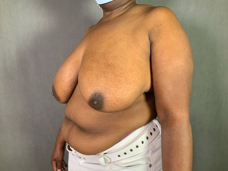 Breast Reduction Before & After Gallery - Patient 167408719 - Image 3