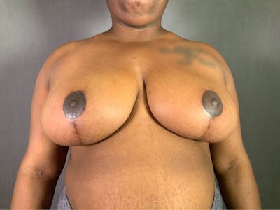 Breast Reduction Before & After Gallery - Patient 167408720 - Image 2