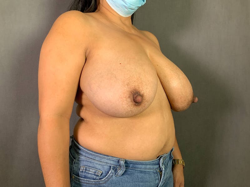 Breast Reduction Before & After Gallery - Patient 167408728 - Image 3