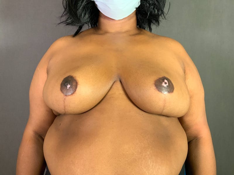 Breast Reduction Before & After Gallery - Patient 167408750 - Image 2