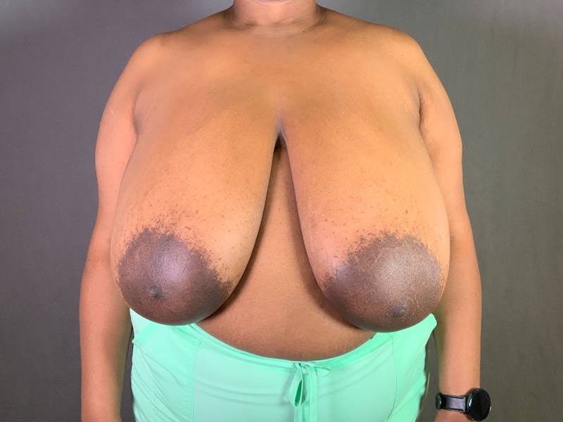 Breast Reduction Before & After Gallery - Patient 167408750 - Image 1