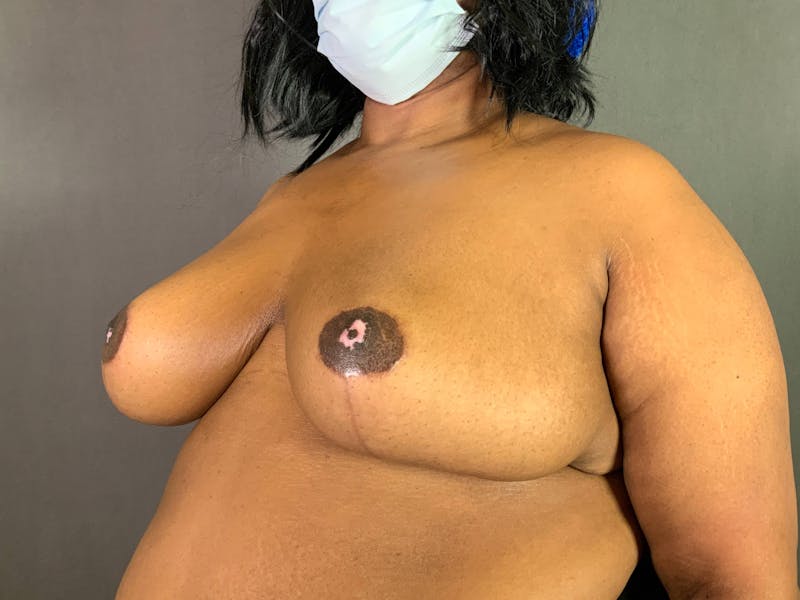 Breast Reduction Before & After Gallery - Patient 167408750 - Image 4
