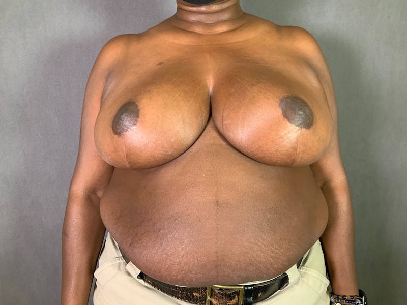 Breast Reduction Before & After Gallery - Patient 167408754 - Image 2