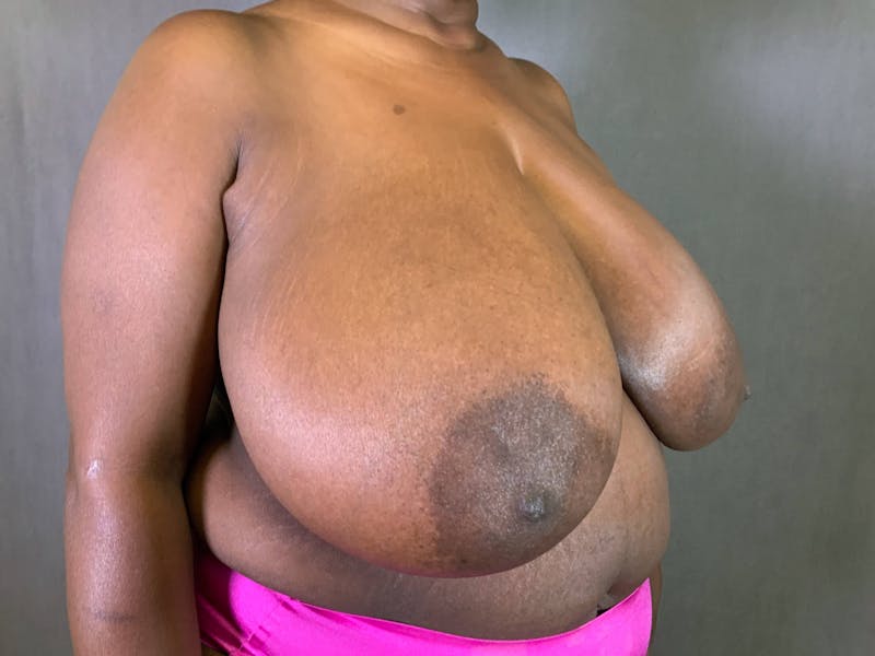 Breast Reduction Before & After Gallery - Patient 167408754 - Image 3