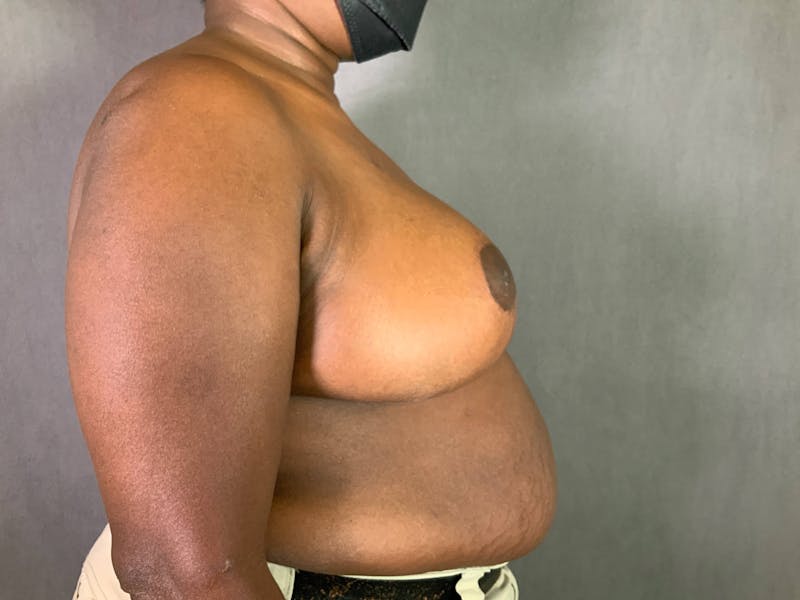 Breast Reduction Before & After Gallery - Patient 167408754 - Image 6