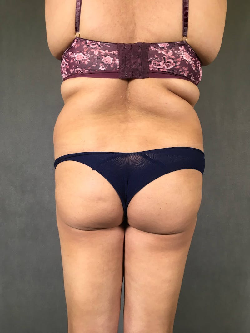 Brazilian Butt Lift Before & After Gallery - Patient 167408768 - Image 1