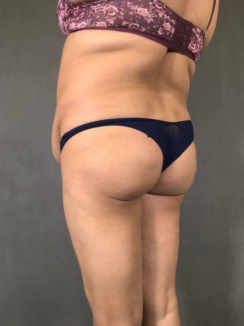 Brazilian Butt Lift Before & After Gallery - Patient 167408768 - Image 3