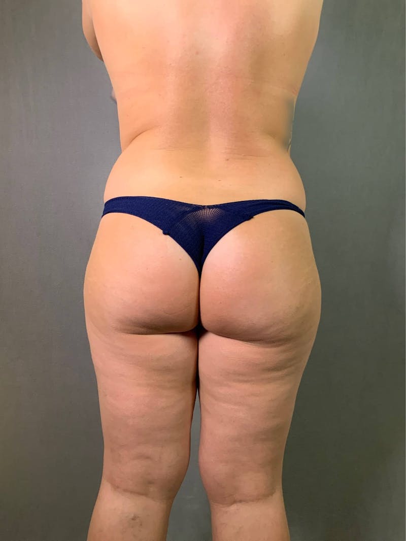 Brazilian Butt Lift Before & After Gallery - Patient 167408769 - Image 1