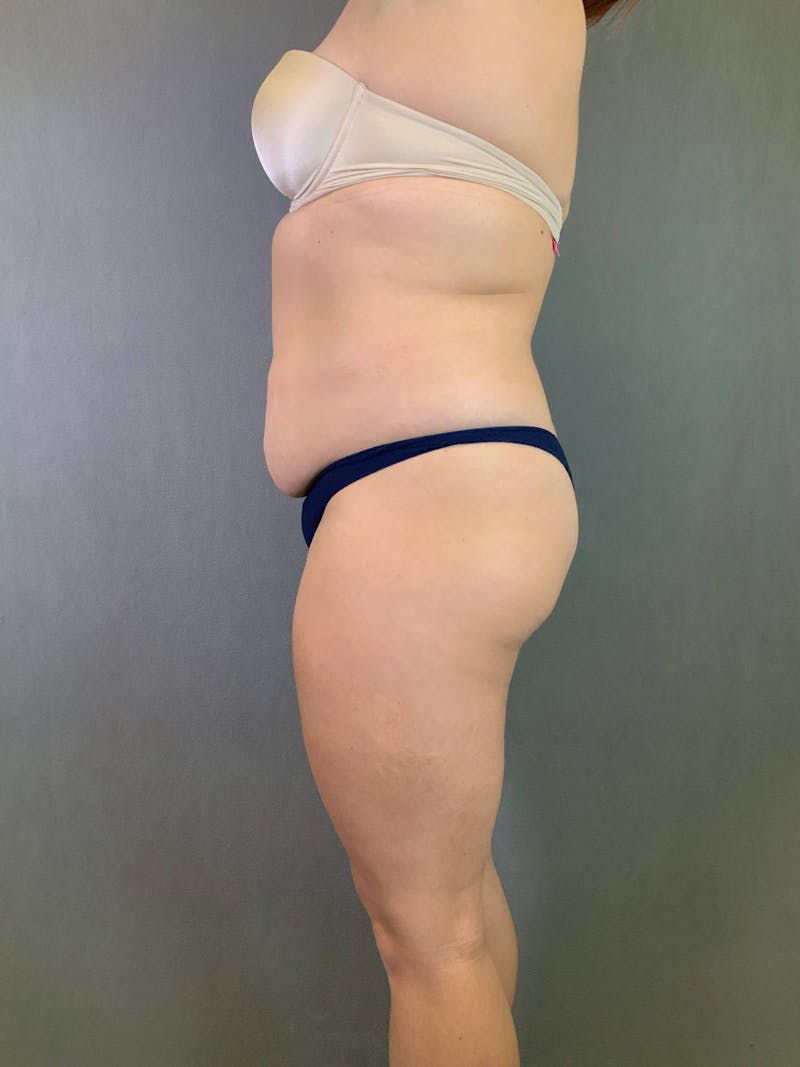 Brazilian Butt Lift Before & After Gallery - Patient 167408771 - Image 3