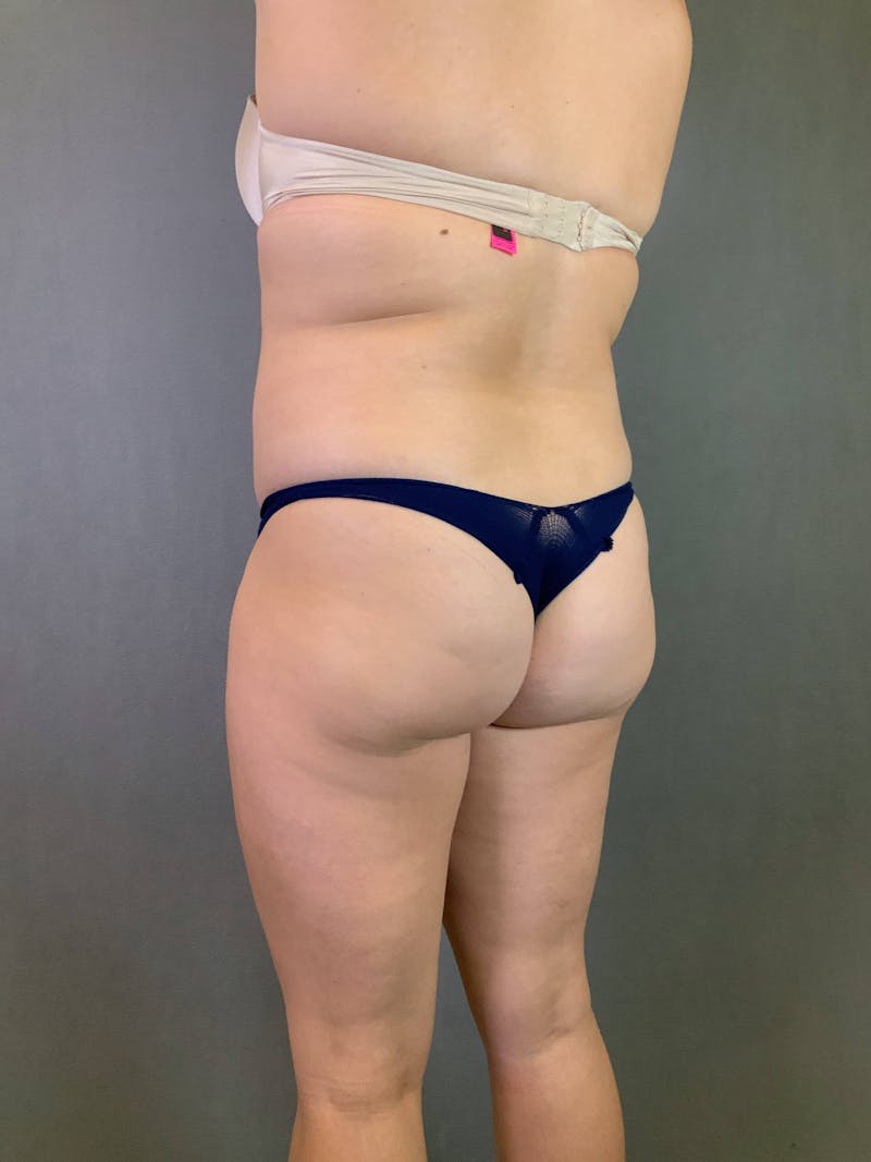 Brazilian Butt Lift Before & After Gallery - Patient 167408771 - Image 5