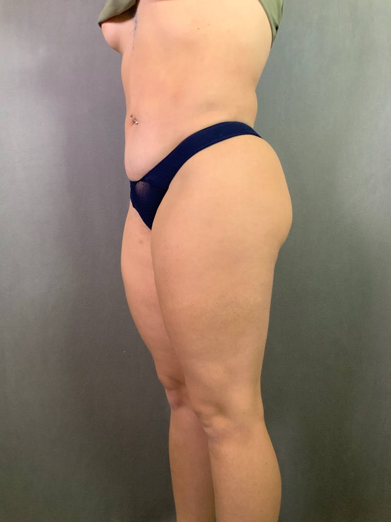 Brazilian Butt Lift Before & After Gallery - Patient 167408771 - Image 6